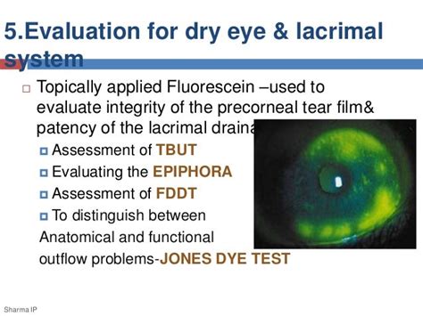 tear test fluorescein stain and tonometery|ophthalmic test for tear stain.